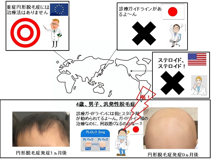 円形脱毛症　病院
